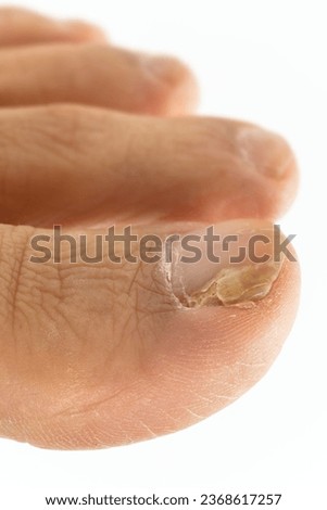 Toenail athlete's foot on white background