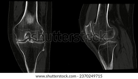 CT Scan of Knee joint sagittal and coronal in case fracture patella bone. Royalty-Free Stock Photo #2370249715