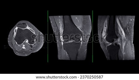 Magnetic resonance imaging or MRI of  knee joint c for detect tear or sprain of the anterior cruciate  ligament (ACL) Royalty-Free Stock Photo #2370250587