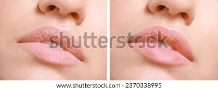 Young woman before and after treatment of dry lips, closeup Royalty-Free Stock Photo #2370338995