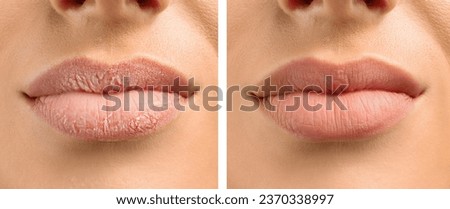 Young woman before and after treatment of dry lips, closeup Royalty-Free Stock Photo #2370338997