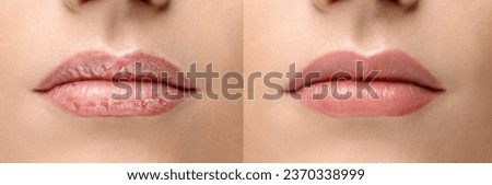 Young woman before and after treatment of dry lips, closeup Royalty-Free Stock Photo #2370338999