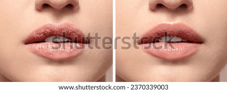 Young woman before and after treatment of dry lips, closeup Royalty-Free Stock Photo #2370339003