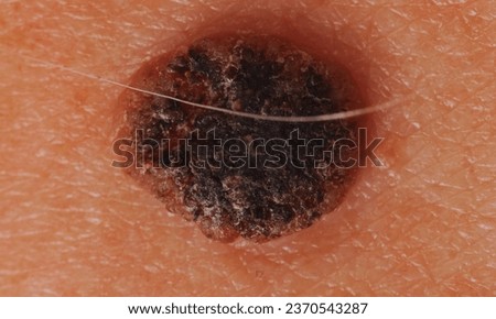 lose up picture of skin cancer(Melanoma)