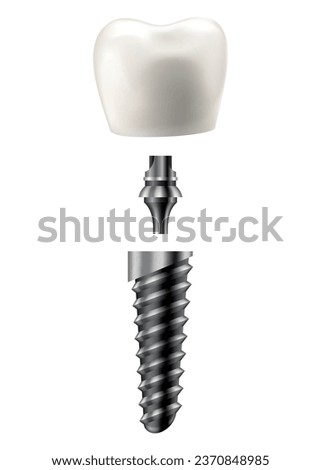 Dental implant structure. Medical educative infographic poster. Teeth implant, realistic vector design of dentistry. Implant screw, healthcare, dentist and orthodontist treatment Royalty-Free Stock Photo #2370848985