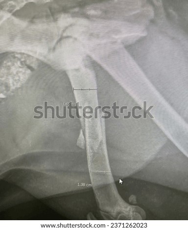 
X-ray image of broken leg bone Ready to measure size to prepare for surgery.