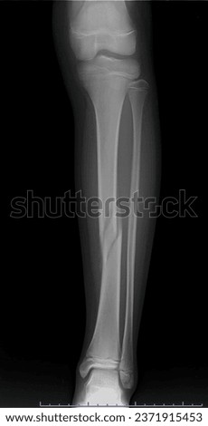This is an x-ray picture of the leg, Ap angle, and a broken bone.