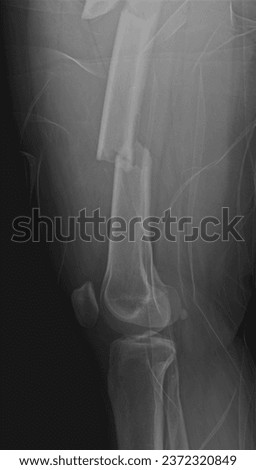 X-ray knee Picture of broken femur bone