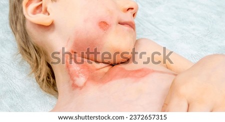 medical procedure dressing a boy with a first-degree burn from boiling water on his face, neck and chest Royalty-Free Stock Photo #2372657315