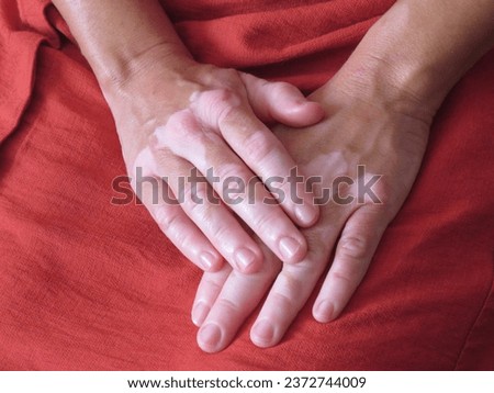 Vitiligo hands medical skin care Royalty-Free Stock Photo #2372744009
