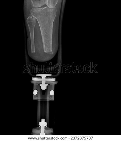 An x-ray image of the prosthetic leg shows parts and leg bones.