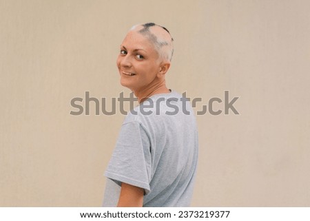 Real alopecia areata in a young girl. A bald head in a person. Diffuse alopecia. Androgenic alopecia. Hair loss. Bald spots on the head. Trichology. High quality photo Royalty-Free Stock Photo #2373219377