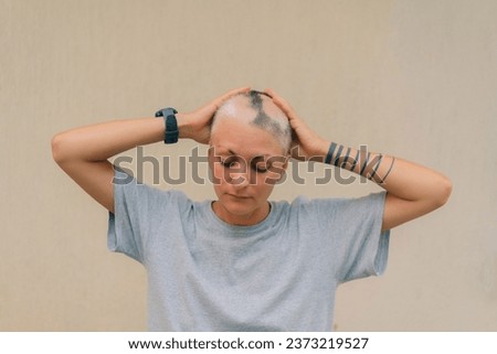Real alopecia areata in a young girl. A bald head in a person. Diffuse alopecia. Androgenic alopecia. Hair loss. Bald spots on the head. Trichology. High quality photo Royalty-Free Stock Photo #2373219527