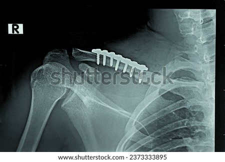 film x-ray of clavicle radiograph showing fracture clavicle bone with open reduction internal fixation (ORIF) with plate and screws. medical imaging concept. Royalty-Free Stock Photo #2373333895