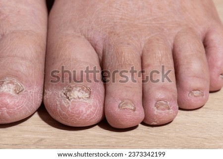 Cancer chemotherapy cause swelling of ankles (ankle oedema) , 
 skin to become dry, dark or peel and nails brittle or flaky. Royalty-Free Stock Photo #2373342199