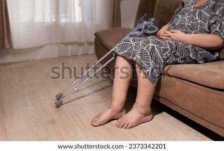 Senior woman that leg is edema (swelling) after cancer treatment.