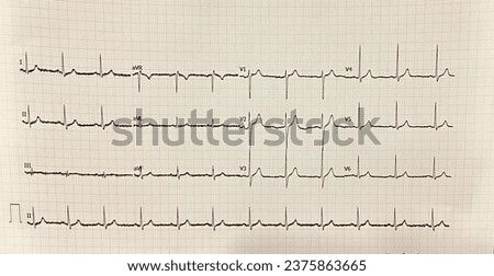 normal ECG. Echocardiography of a normal individual. used in medical practice to determine heart diseases. Royalty-Free Stock Photo #2375863665