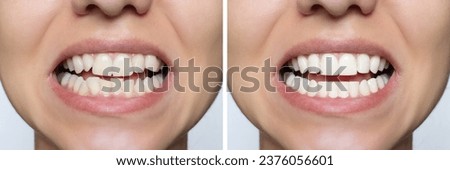 Young woman's smile before and after teeth straightening. Ideal, beautiful shape of teeth on the upper and lower jaw after installing veneers or braces. Bleaching. Dental clinic patient.