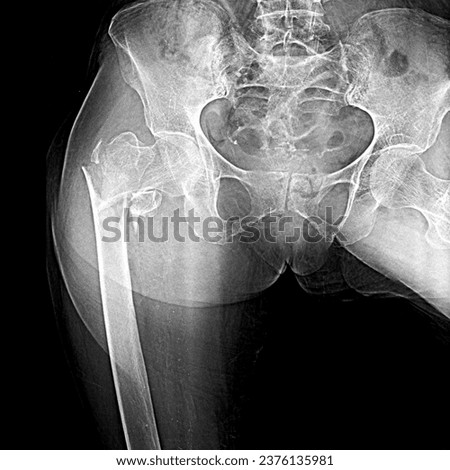 X ray Hip Joint showing Right Hip Fracture. Hip Joint Fracture. Royalty-Free Stock Photo #2376135981
