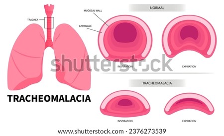 Lung anatomy with trachea exhalation inhalation breathe in common cold Royalty-Free Stock Photo #2376273539