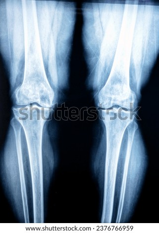 Plain X ray of both knee joints shows apparent joint osteoarthritis according to Kellgren and Lawrence system for classification of osteoarthritis with definite osteophytes and joint space narrowing  Royalty-Free Stock Photo #2376766959