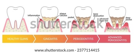The stages of periodontal disease. dental and oral health care Royalty-Free Stock Photo #2377114415