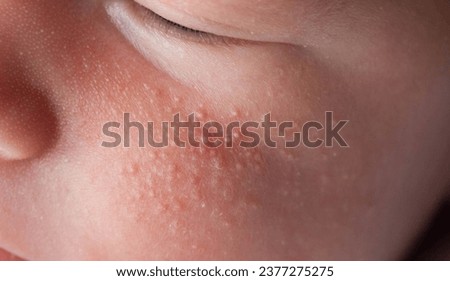 Allergic pimples in a newborn on the face. Pathogenesis, acne of newborns, close-up Royalty-Free Stock Photo #2377275275