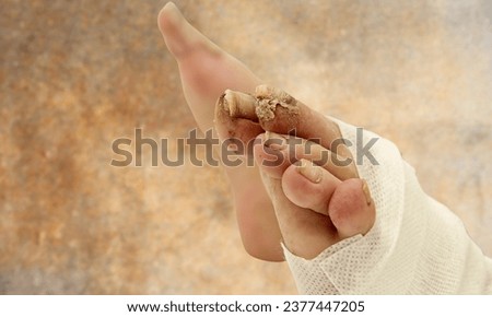 Distal subungual onychomycosis Fungal Nail Infection. Onychomycosis or tinea unguium. Four classic types of 
onychomycosis,Distal lateral subungual onychomycosis of the finger Royalty-Free Stock Photo #2377447205