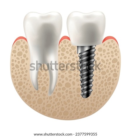 Dental implant structure. Medical educative infographic poster. Teeth implant, realistic vector design of dentistry. Implant screw, healthcare, dentist and orthodontist treatment
