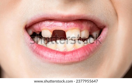 Child bad teeth. Boy kid lost front tooth, toothache. Child without one front tooth. No teeth. Yellow teeth. Bad dental health, no teeth, no fluoride, tooth erosion. Portrait boy with bad teeths. Royalty-Free Stock Photo #2377955647