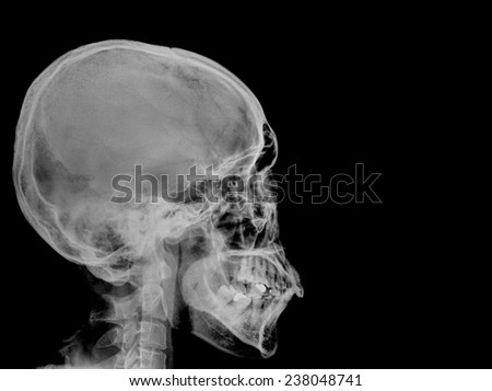 X-ray Skull ( Skull Lateral )