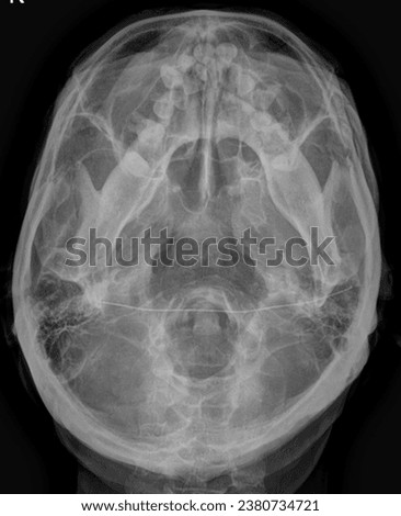 This is a picture of an x-ray taken of a skull. submentovertex view