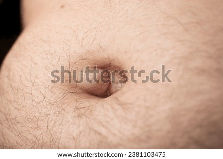 An umbilical hernia appears as a painless lump in or near the belly button (navel) Royalty-Free Stock Photo #2381103475