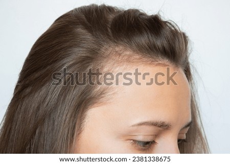 Cropped head shot of a young Caucasian woman with receding hairline on her forehead and temples. Baldness. Close-up, side view. Hair care and treatment concept. Hair loss, alopecia. Royalty-Free Stock Photo #2381338675
