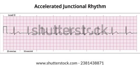 ECG Accelerated Junctional Rhythm - Escape Rhythm - 8 Second ECG Paper - Electrocardiogram Vector Medical Illustration Royalty-Free Stock Photo #2381438871