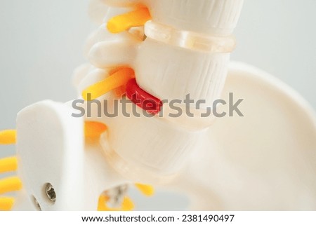 Spinal nerve and bone, Lumbar spine displaced herniated disc fragment, Model for treatment medical in the orthopedic department. Royalty-Free Stock Photo #2381490497