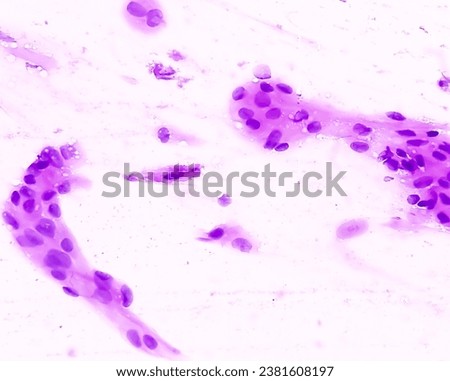 Light micrograph of a vaginal smear showing adenocarcinoma cells (center). Vaginal cancer. Inflammatory smear with HPV related changes. Cervical cancer. SCC.