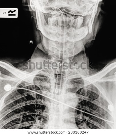 X ray of neck and cervical spine, front and side view.