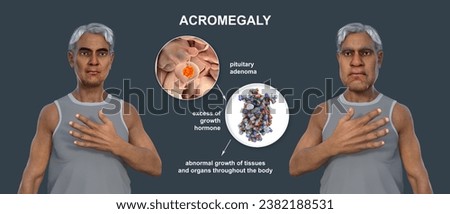 Acromegaly, 3D illustration showing an increase in the size of the hands and face due to overproduction of somatotrophin caused by a tumor of the pituitary gland.