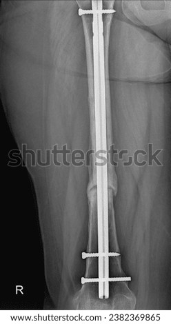 Medical X-ray of a fractured femur bone, illustrating a common orthopedic injury. Royalty-Free Stock Photo #2382369865