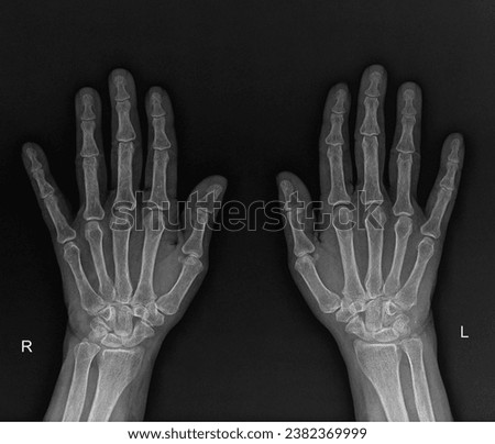 X-ray of the hand, demonstrating metacarpal and phalangeal bone alignment. Royalty-Free Stock Photo #2382369999