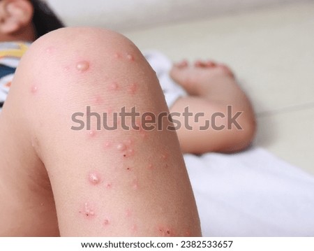 virus hfmd leg knee child asian allergic blister chicken pox dermatology measles medical skin disease reaction red stickers Royalty-Free Stock Photo #2382533657