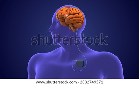 Deep brain stimulation medical concept 3D Illustration