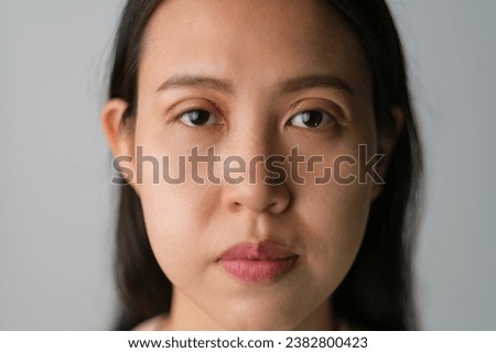 Asian woman with ongoing upper blepharoplasty surgery concept. Medical double eyelid plastic surgery, front view face showing bruises on the eyelids. On white background.