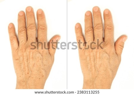 Age spots on the hands before and after removal using a lightening whitening cream. Rejuvenation procedure, laser treatment, peeling. Liver spots, lentigo, sun spots. Cosmetology and beauty concept Royalty-Free Stock Photo #2383113255