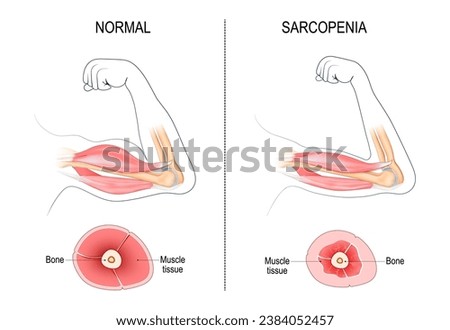 Sarcopenia. Age-related muscle atrophy. Comparison and Difference between normal arm and Muscle loss. Cross section of muscle of Young active person, and Old passive human. Vector illustration Royalty-Free Stock Photo #2384052457