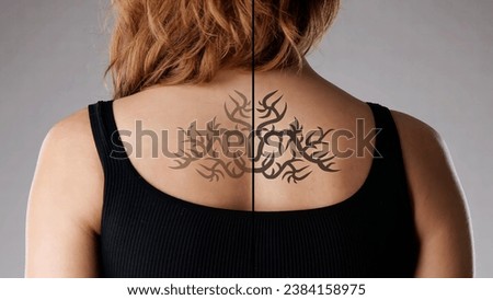 Laser Tattoo Removal On Woman's Back. Body Skin Royalty-Free Stock Photo #2384158975