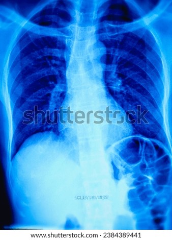 Film chest x-ray show abnormal human's chest.