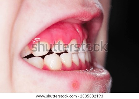 Gingivitis in children inflammation of the gums in a child Royalty-Free Stock Photo #2385382193