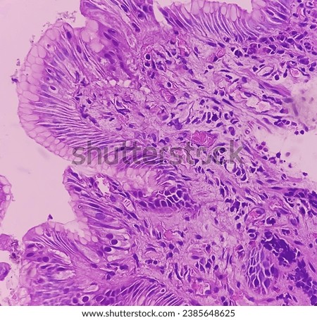 Tissue from antrum of stomach (endoscopic biopsy): Chronic nonspecific gastritis. Show gastric mucosa, chronic inflammatory cells infiltration in the lamina propria. Royalty-Free Stock Photo #2385648625